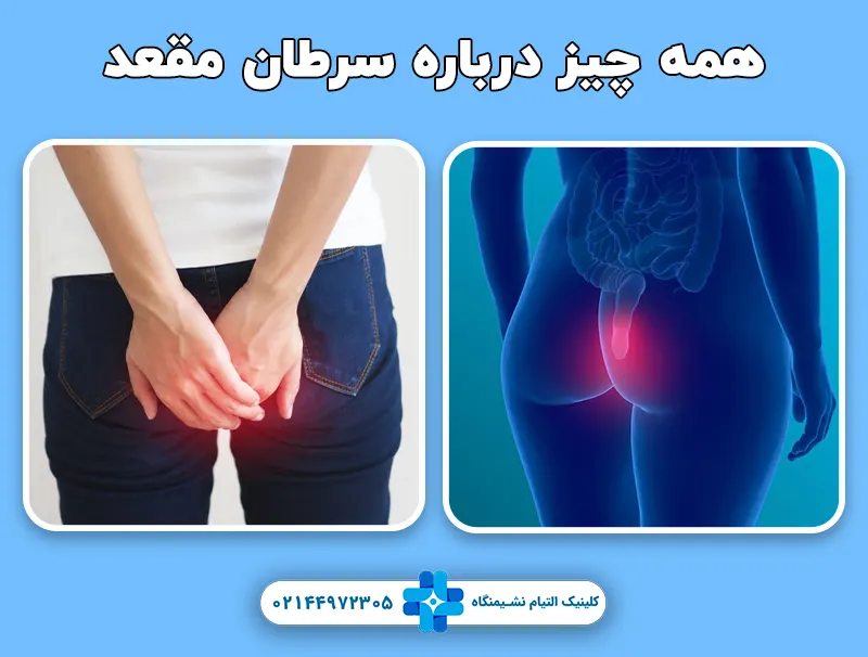 همه چیز درباره سرطان مقعد