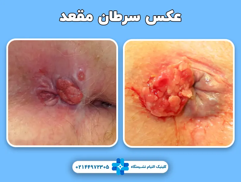 عکس سرطان مقعد