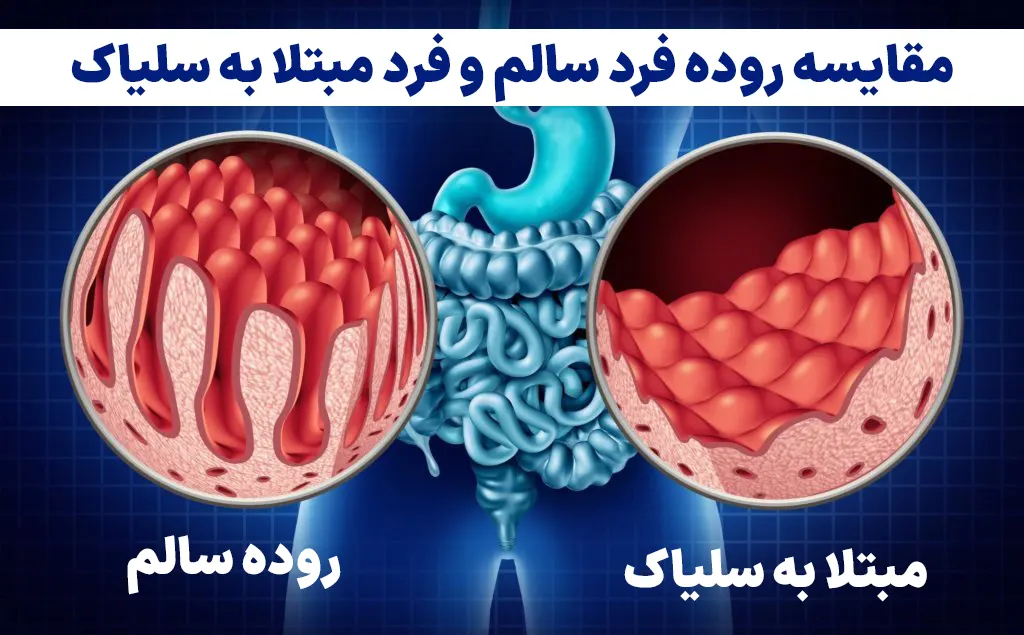 بیماری سلیاک