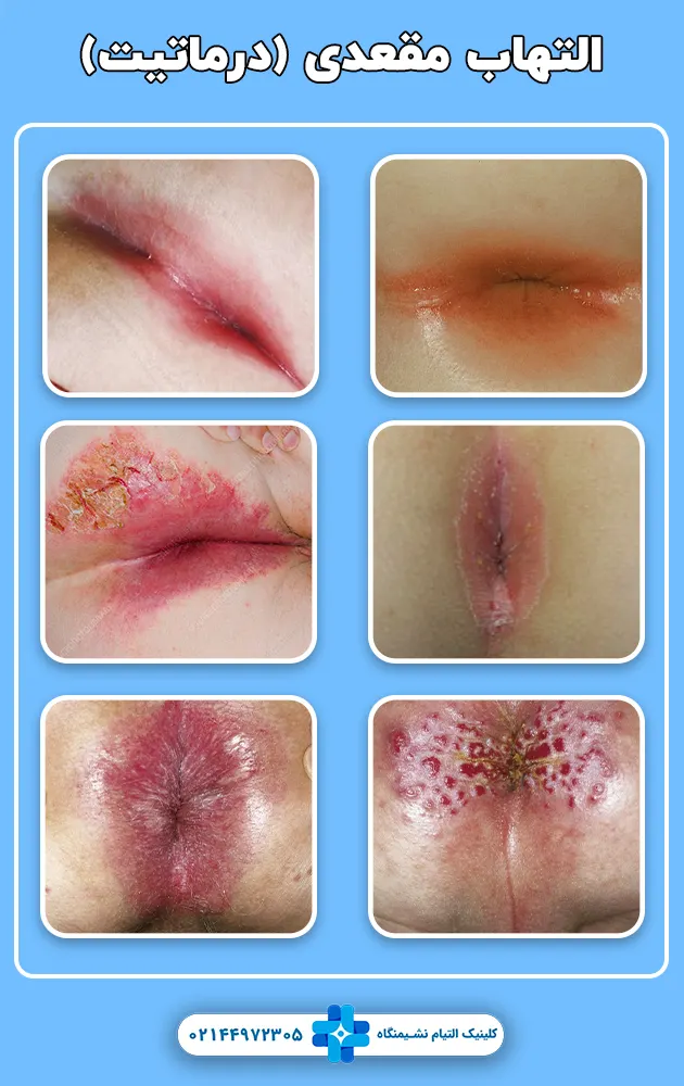 التهاب مقعد