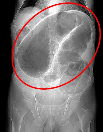 تصویربرداری برای انسداد روده بزرگ