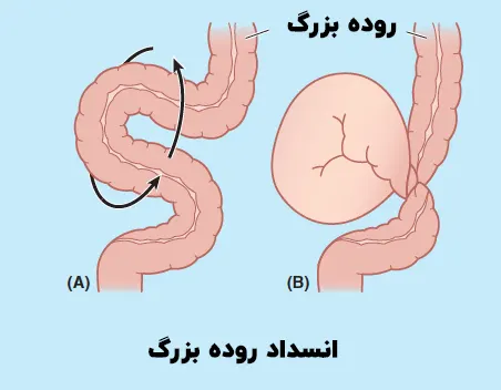 انسداد روده بزرگ