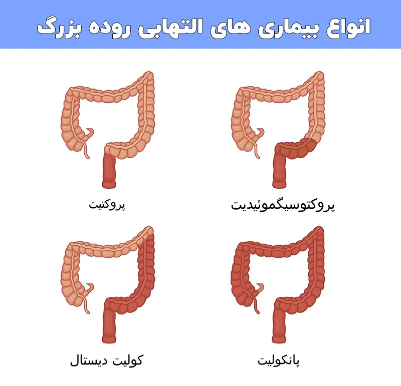 انواع بیماری التهابی روده بزرگ