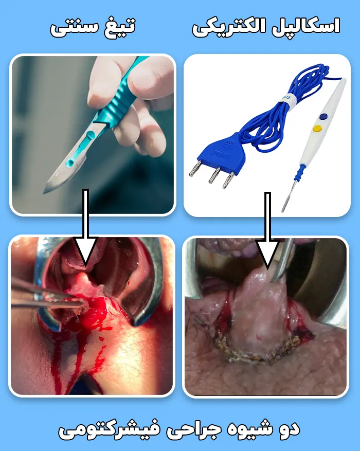 دو روش فیشرکتومی