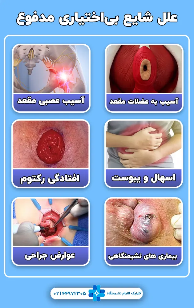 علل شایع بیاختیاری مدفوع