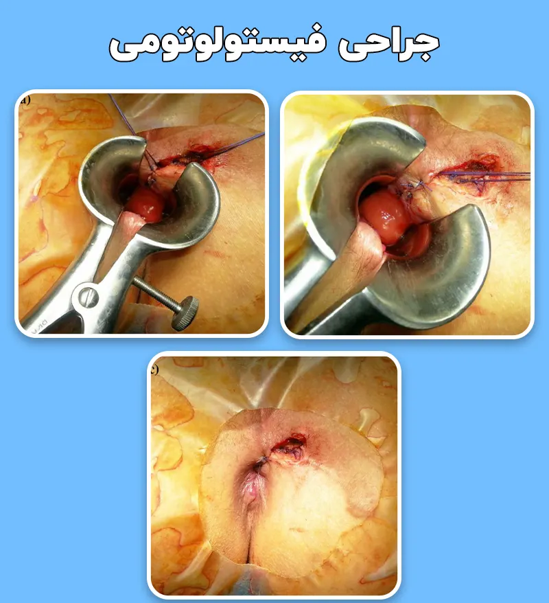 جراحی فیستولوتومی