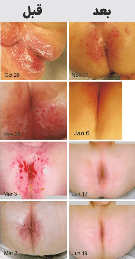 قبل و بعد درمان درماتیت مقعد