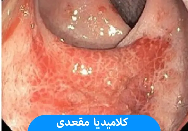 کلامیدیا مقعدی