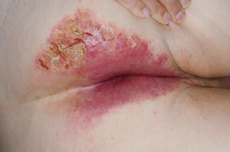 درماتیت مقعد