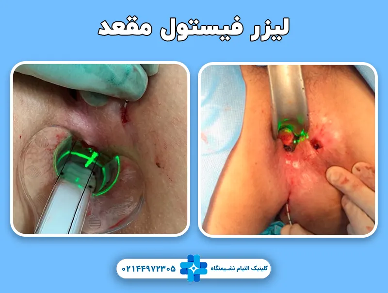 لیزر فیستول مقعدی