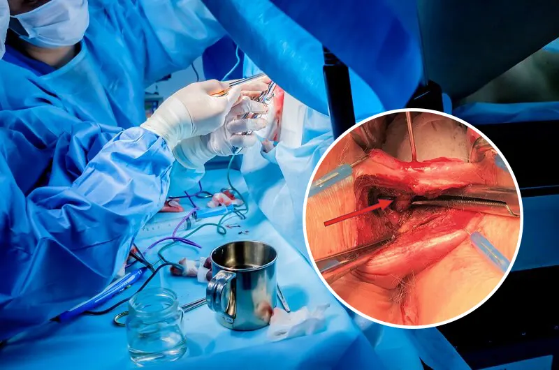 جراحی باز فیستول مقعدی