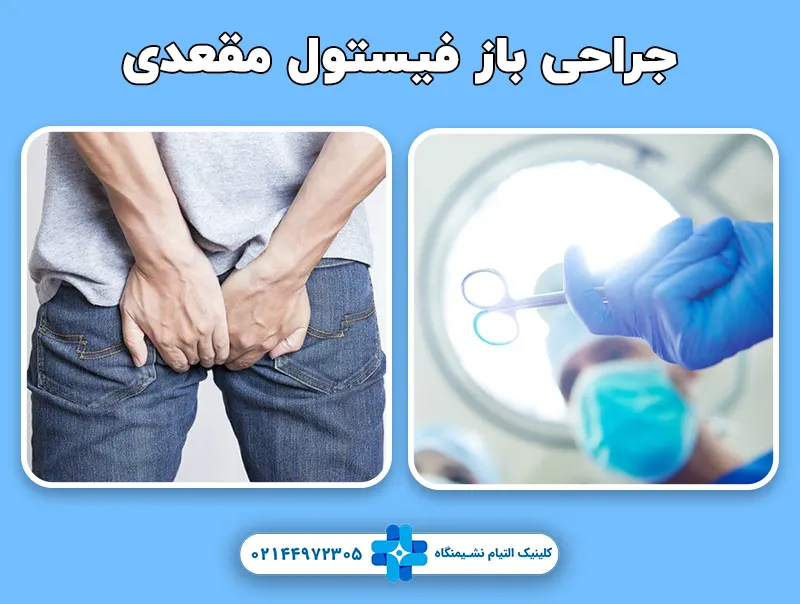 جراحی باز فیستول مقعدی