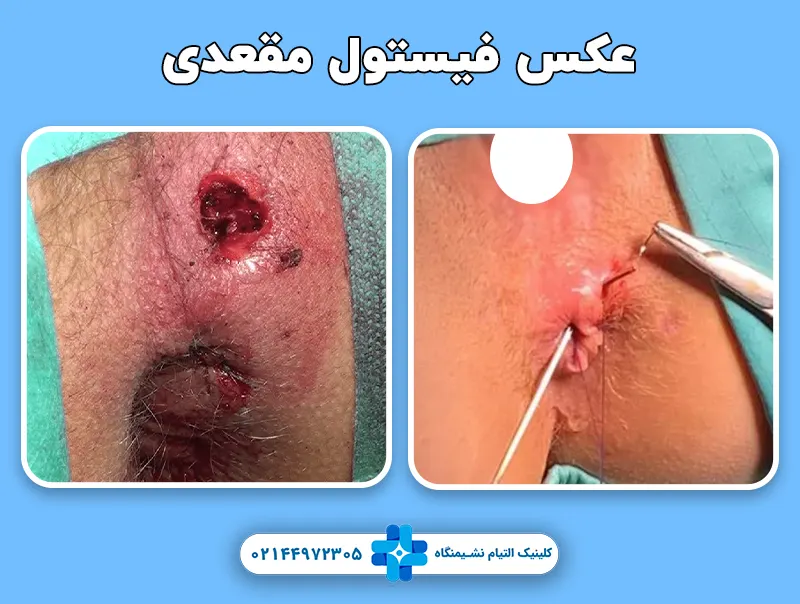 عکس فیستول مقعدی