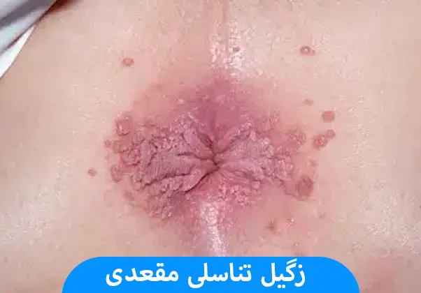 زگیل تناسلی مقعدی