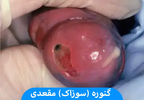 گنوره (سوزاک) مقعدی