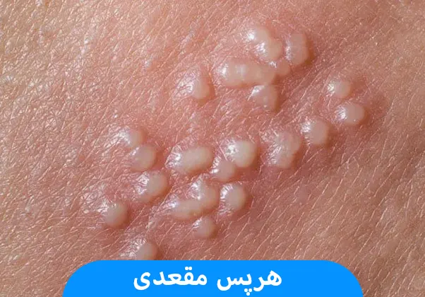 هرپس مقعدی