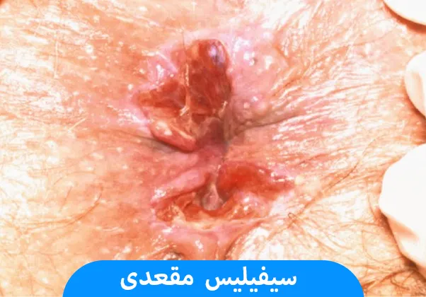 سیفیلیس مقعدی