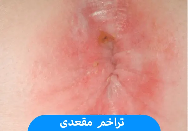 تراخم مقعدی