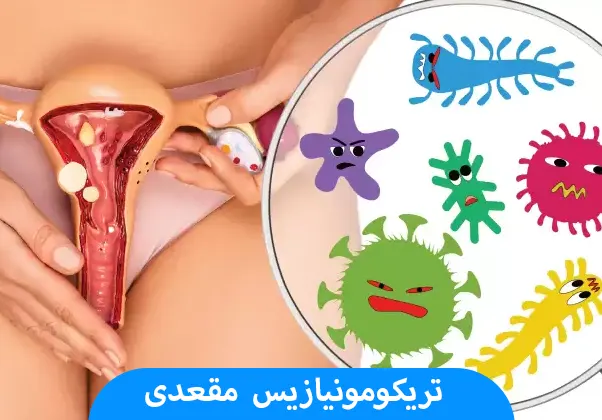 تریکومونیازیس مقعدی