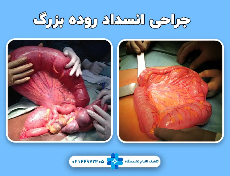 جراحی انسداد روده بزرگ