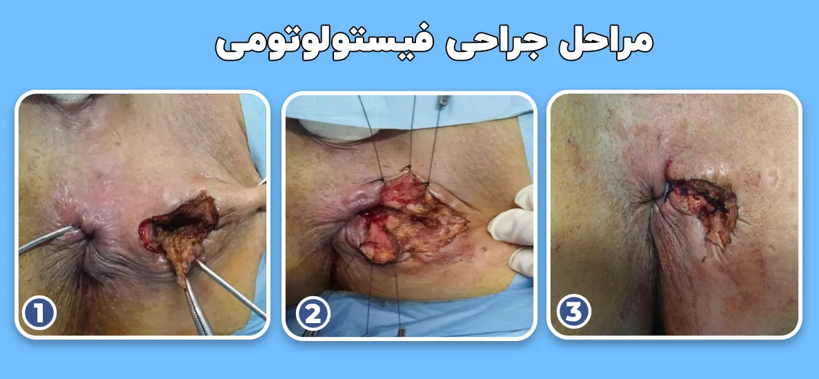 مراحل جراحی فیستولوتومی