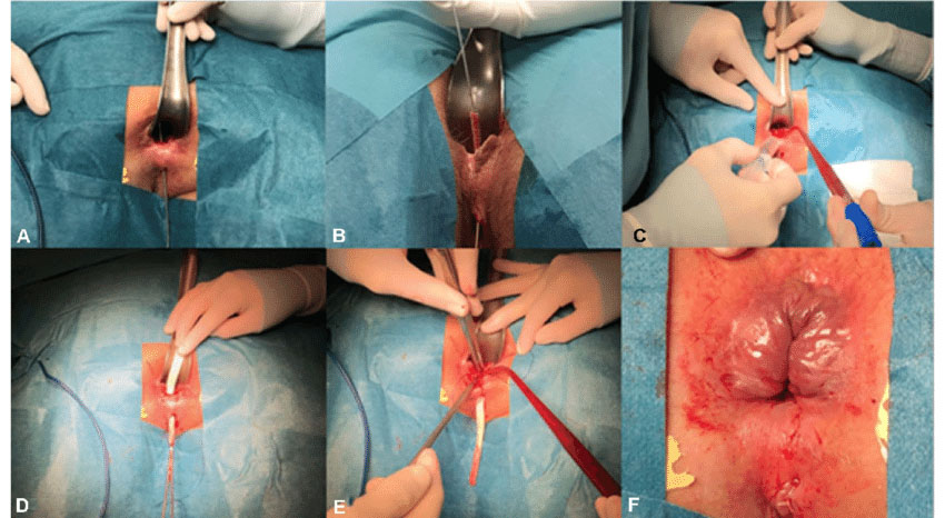 فیستولوتومی