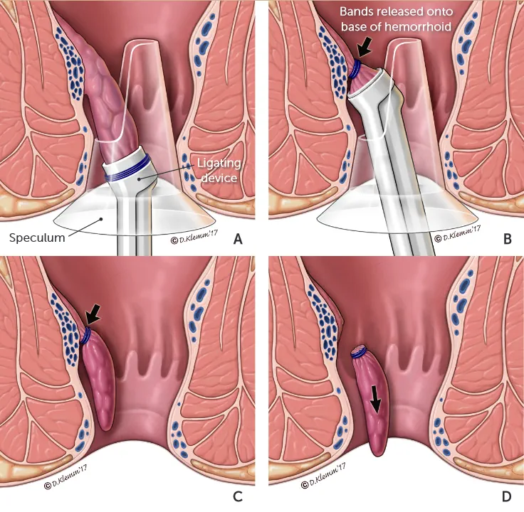 باندینگ هموروئید