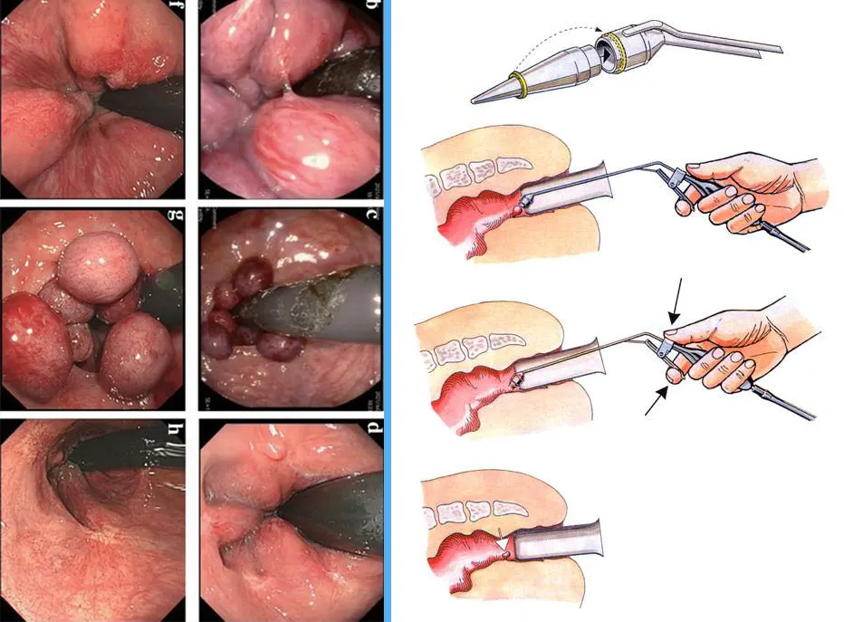 باندینگ هموروئید