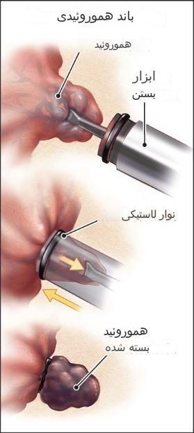 باندینگ هموروئید