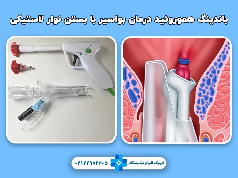 باندینگ هموروئید