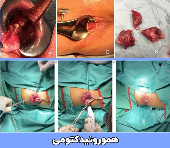 جراحی باز بواسیر یا هموروئیدکتومی