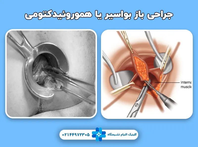 جراحی باز بواسیر یا هموروئیدکتومی