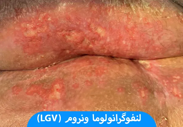 لنفوگرانولوما ونروم (LGV)