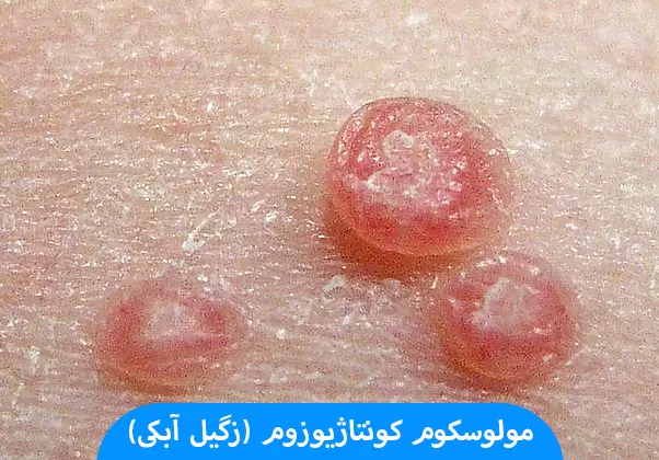 مولوسکوم کونتاژیوزوم (زگیل آبکی)