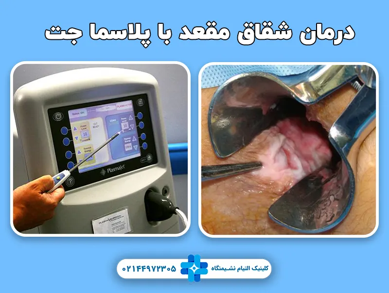 درمان شقاق با پلاسما جت