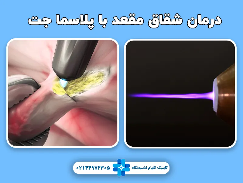 درمان شقاق با پلاسما جت