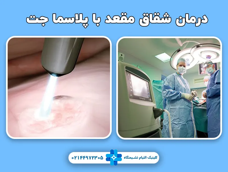 درمان شقاق با پلاسما جت