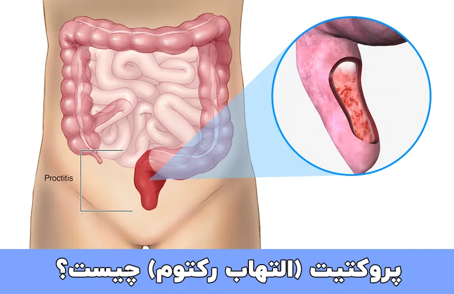 پروکتیت (التهاب رکتوم) چیست؟