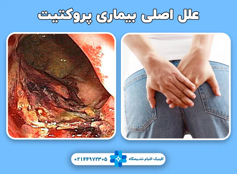 بیماری پروکتیت