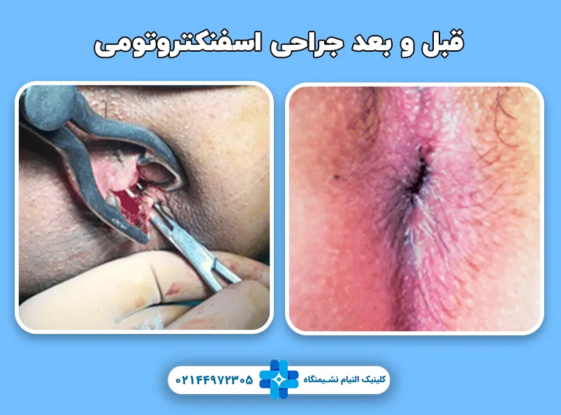 قبل و بعد جراحی اسفنکتروتومی