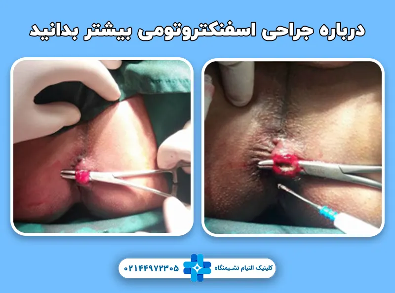 اسفنکتروتومی