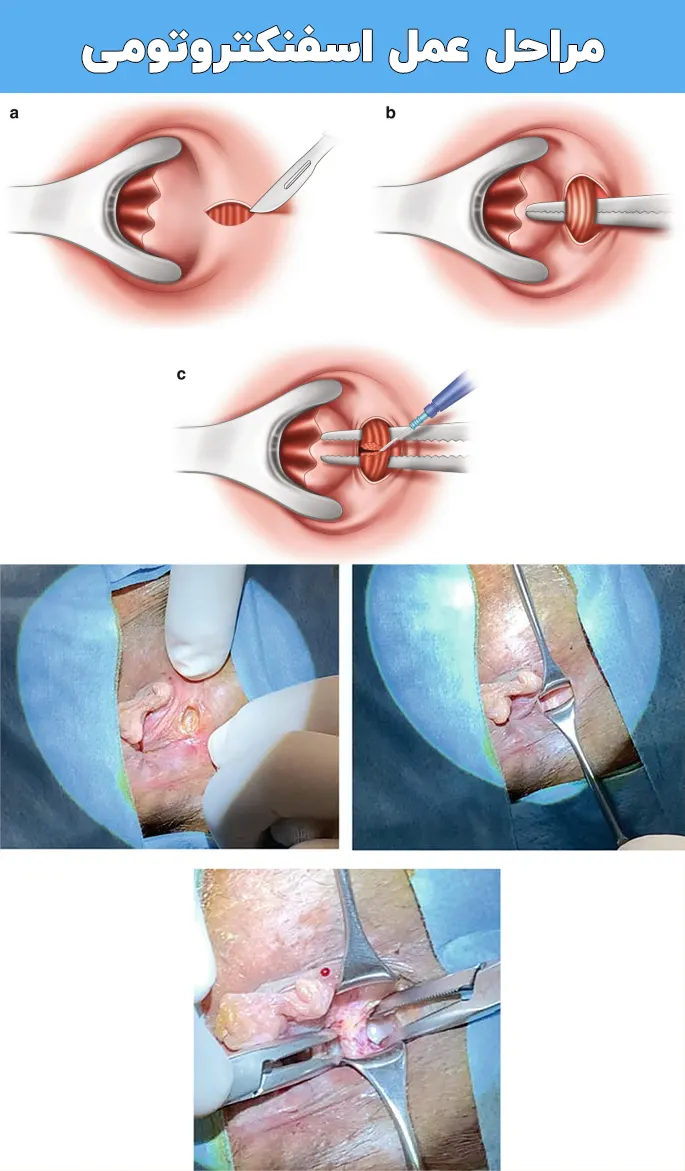 اسفنکتروتومی