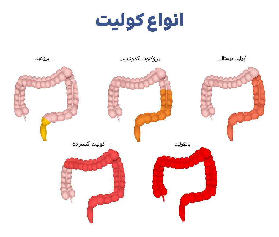 انواع کولیت