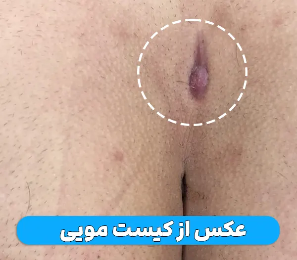 عکس کیست مویی