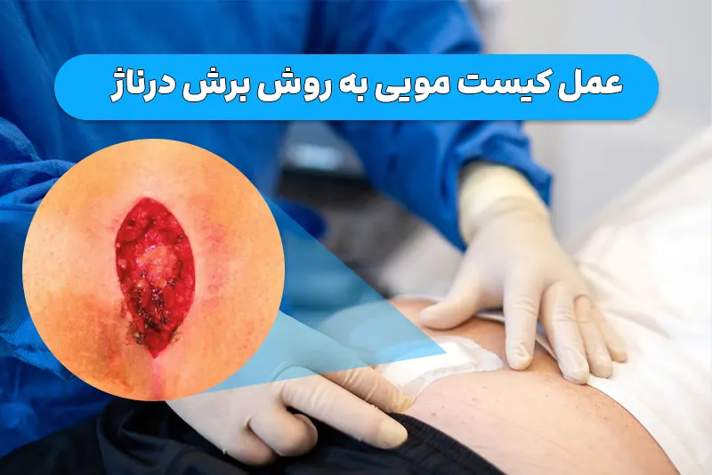 عمل کیست مویی به روش برش درناژ