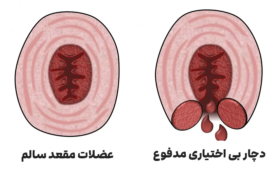 بیاختیاری مدفوع چیست؟