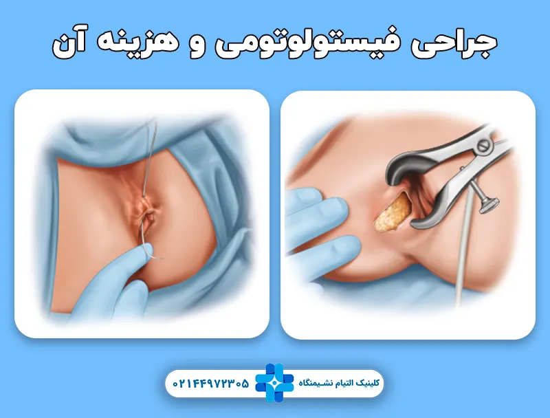 جراحی فیستولوتومی