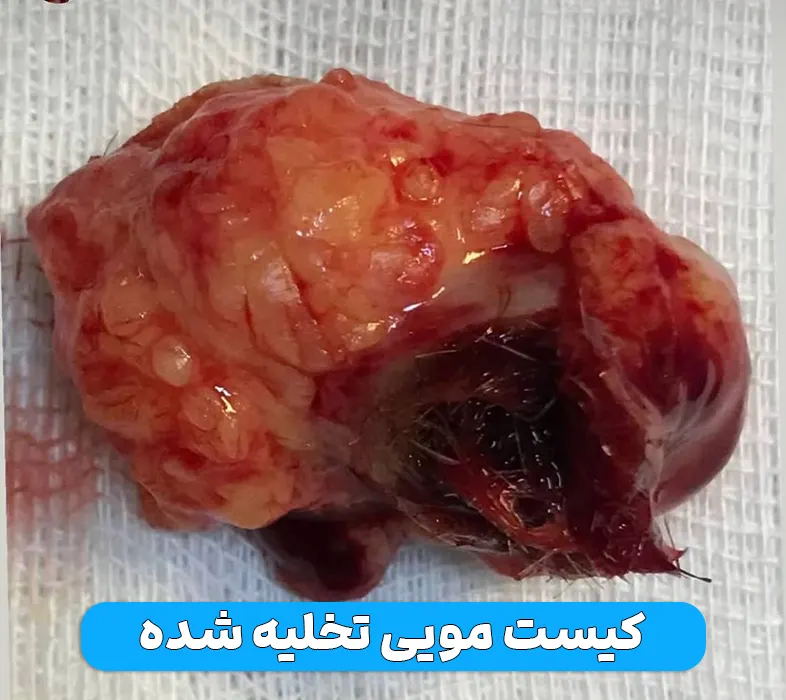 کیست مویی تخلیه شده