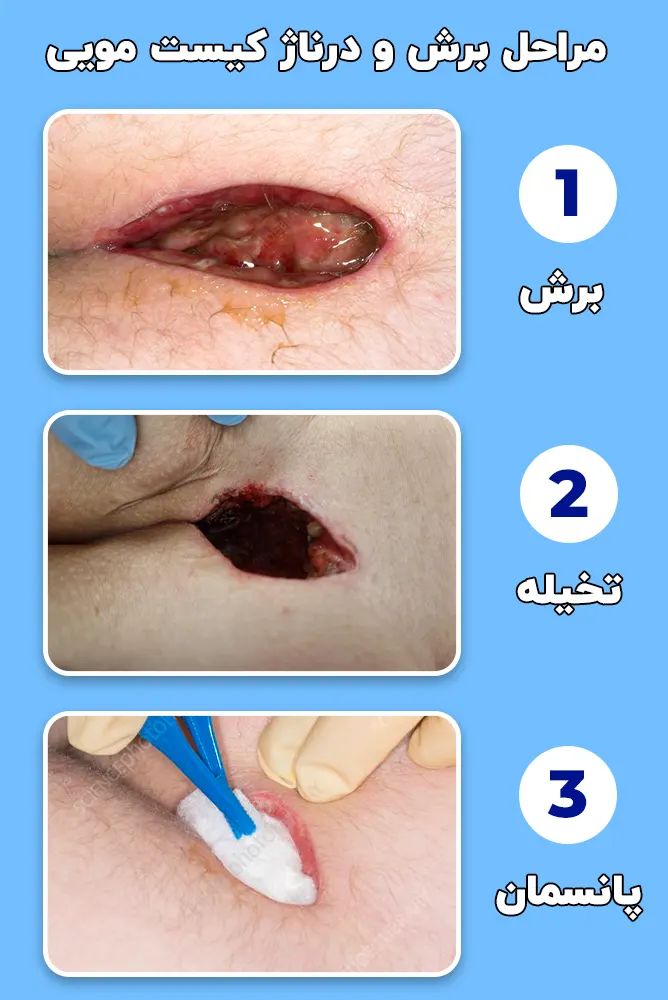 مراحل برش و درناژ کیست مویی