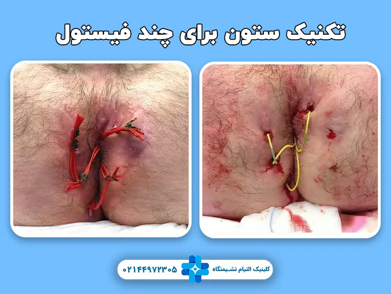 فیستول چندگانه و ستون